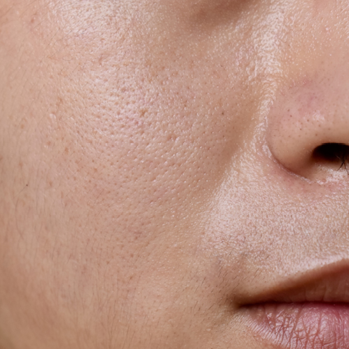 Nahaufnahme eines fettigen Nasolabialbereichs