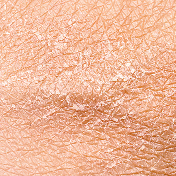 Sehr trockene Haut neigt zu Schuppungen und Rauigkeit Foto von sehr trockener Haut