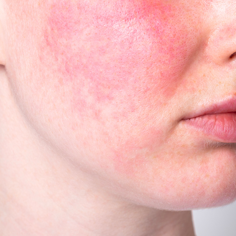 Stark gerötete Haut (Rosacea) an der Wange