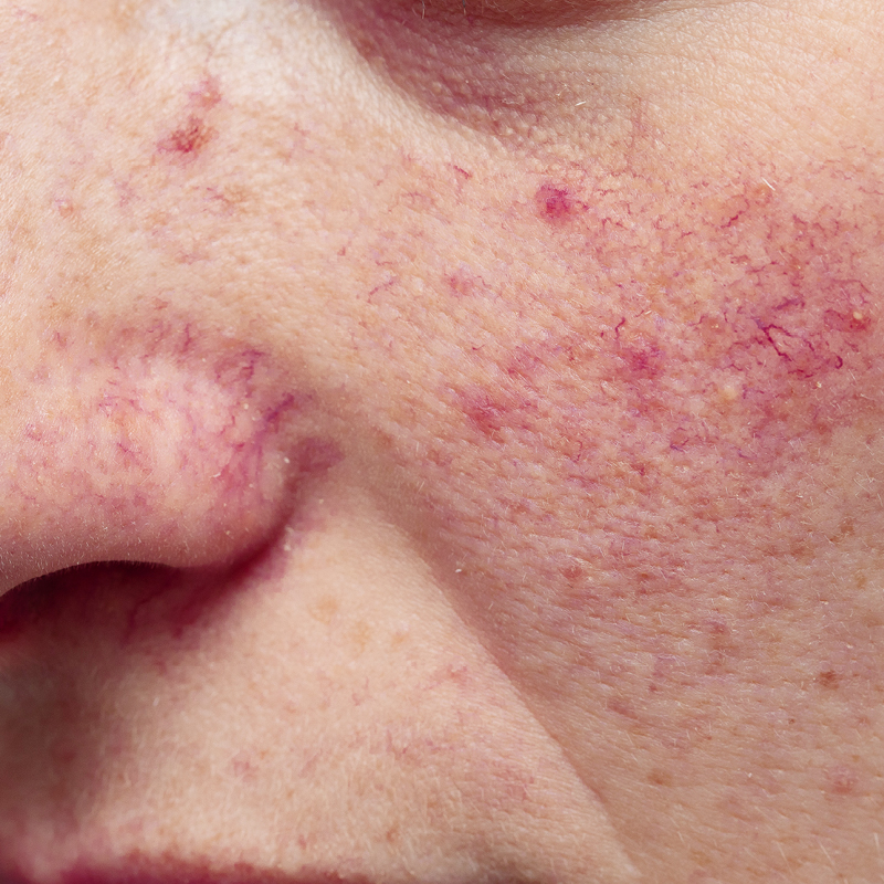 Erweiterte Äderchen (Teleangiektasien) an der Wange