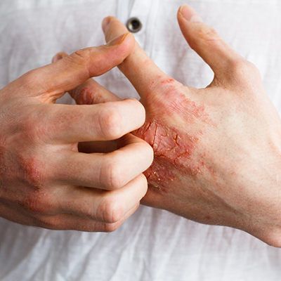 Hände mit Symptomen der Neurodermitis