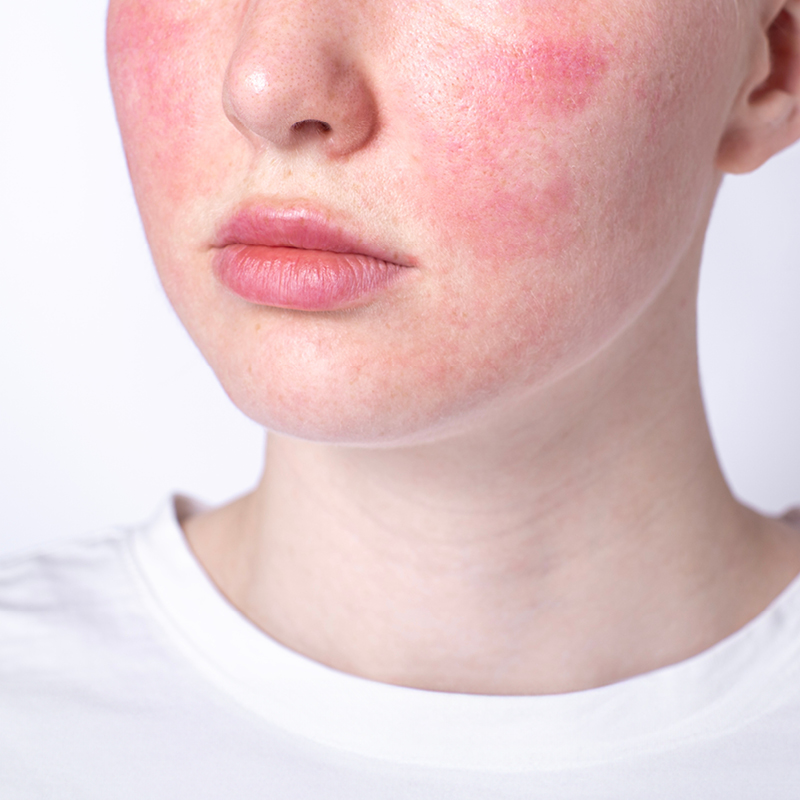 Foto von Rosacea an der Wange