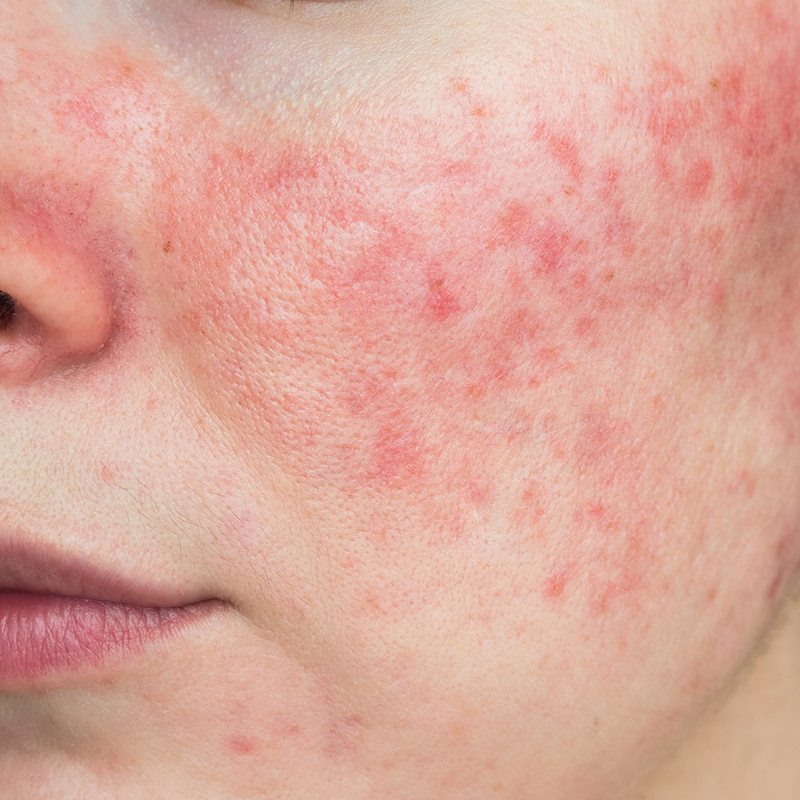 Foto von Papeln und Pusteln bei Rosacea an der Wange