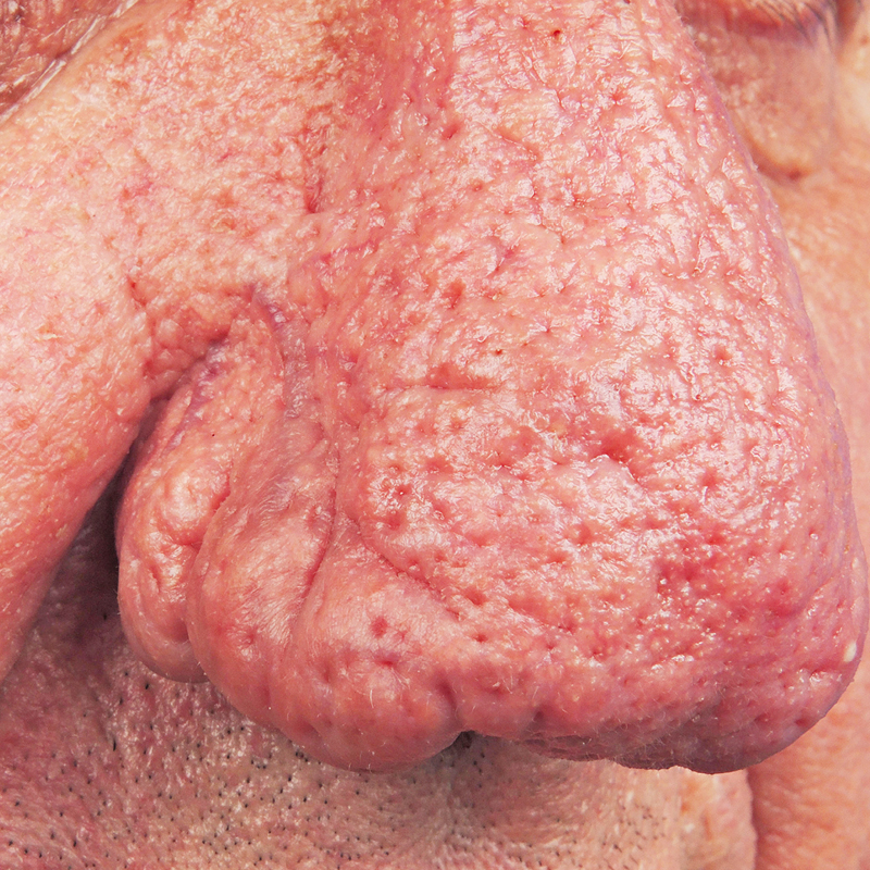 Foto von stark ausgeprägten Wucherungen an der Nase (Rhinophym) bei Rosacea