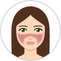 Frau mit Rosacea-Subtyp 1 (Rosacea erythematotelangiectatica) Grafik: Frau mit Rosacea-Subtyp 1 (Rosacea erythematotelangiectatica)