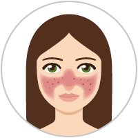 Frau mit Rosacea-Subtyp 2 (Rosacea papulopustulosa) Grafik: Frau mit Rosacea-Subtyp 2 (Rosacea papulopustulosa)