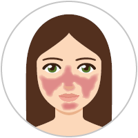 Frau mit Rosacea-Subtyp 3 (Rosacea vom phymatösen Typ) Grafik: Frau mit Rosacea-Subtyp 3 (Rosacea vom phymatösen Typ)