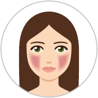 Frau mit Rosacea-Vorstufe Grafik: Frau mit Rosacea-Vorstufe