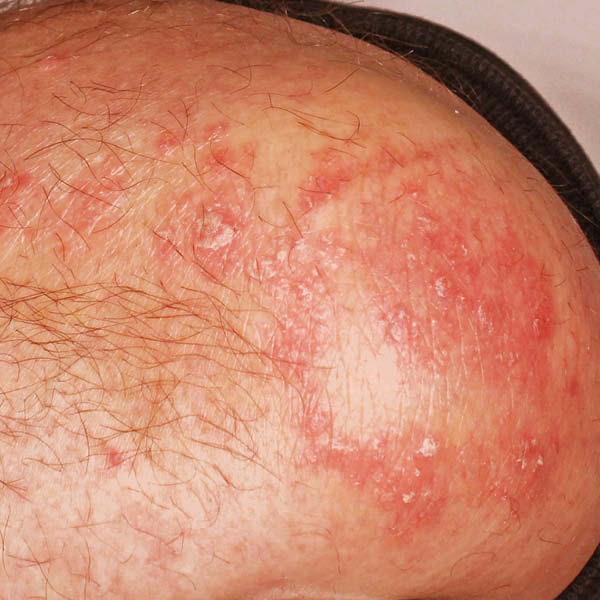 Foto von Schuppenflechte (Psoriasis vulgaris) am Ellenbogen