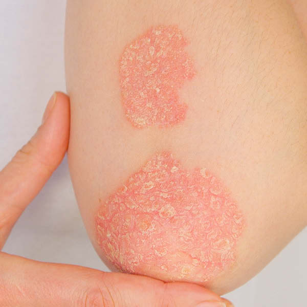 Foto von Schuppenflechte (Psoriasis vulgaris) am Ellenbogen