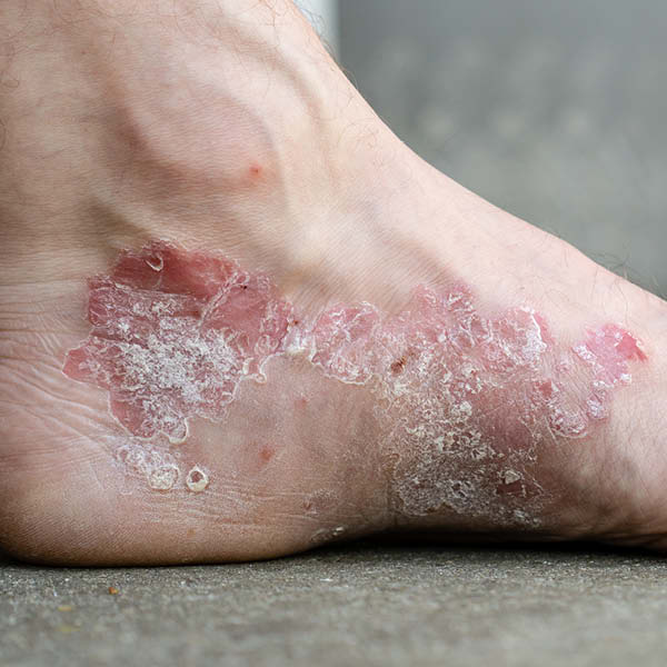 Foto von Schuppenflechte (Psoriasis vulgaris) am Fuß
