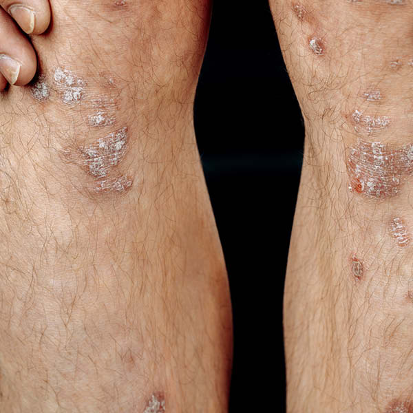 Foto von Schuppenflechte (Psoriasis vulgaris) an Knie und Schienbein