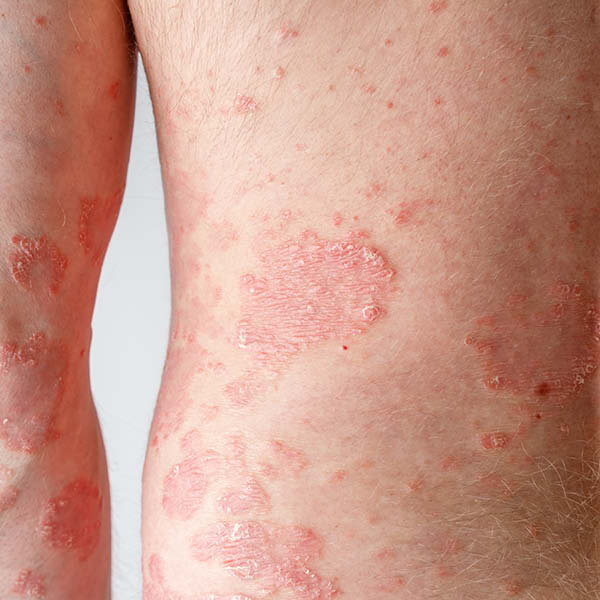 Foto von Schuppenflechte (Psoriasis vulgaris) am unter Rücken