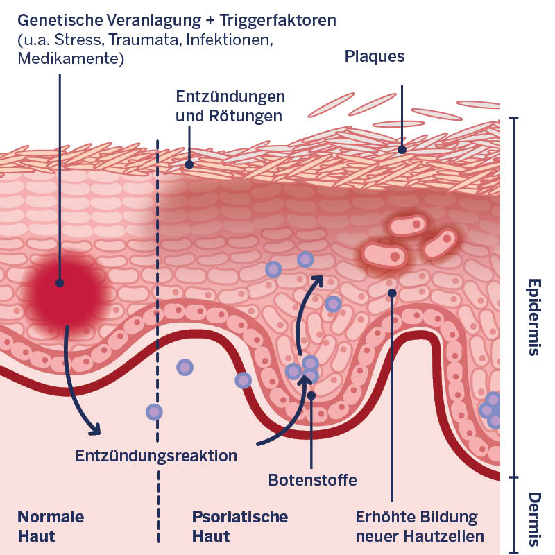 Grafische Darstellung der Prozesse innerhalb der psoriatischen Haut