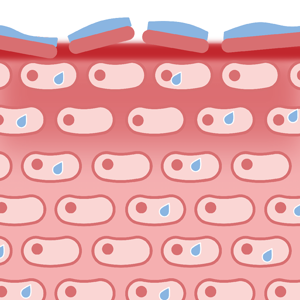 Bei empfindlicher, irritierter Haut ist die Hautbarriere instabil Hautgrafik: Irritierte Haut