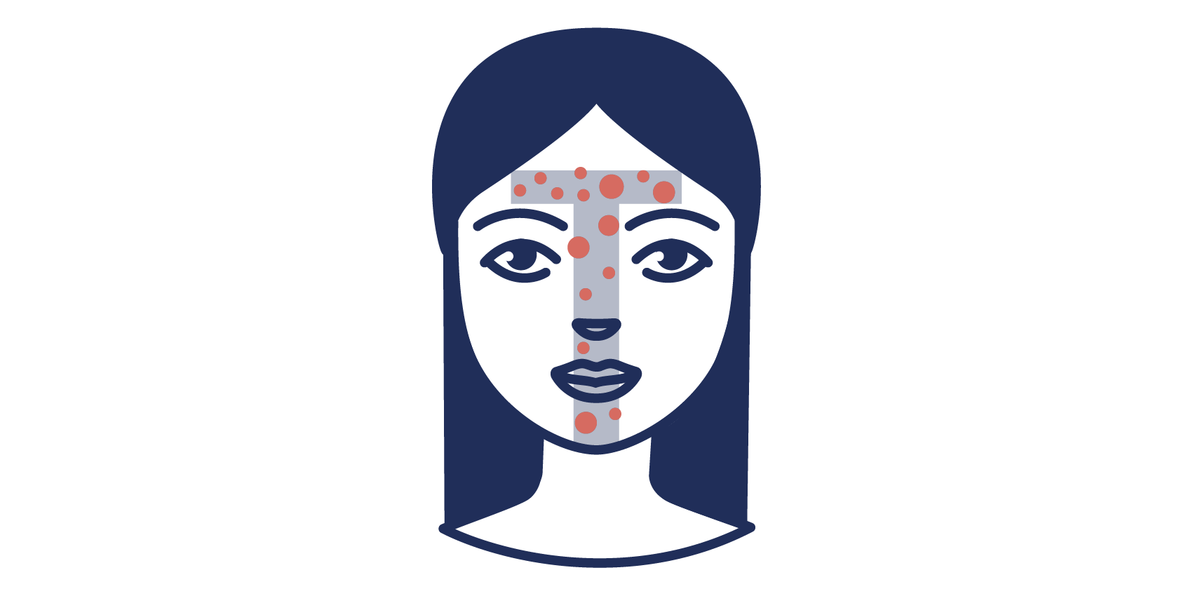 Acne vulgaris sorgt für Pickel und Unreinheiten in der T-Zone Illustration der Acne vulgaris in der T-Zone