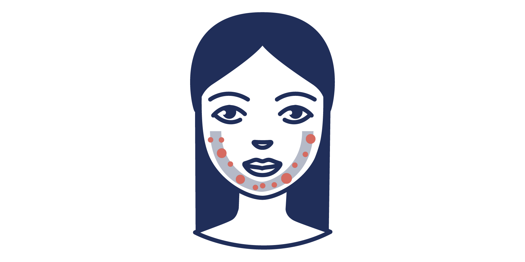 Acne tarda sorgt für Pickel und Unreinheiten in der U-Zone Illustration der Acne tarda in der U-Zone
