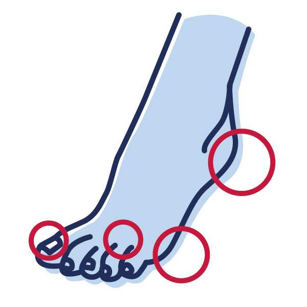 Zeichnung von einem Fuß, bei der Problemzonen markiert sind