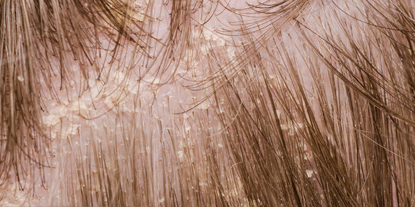 Kopfhaut mit fettigen Schuppen