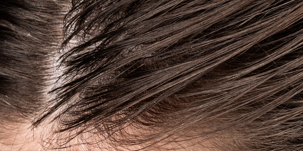 Kopfhaut mit fettigen Haaren
