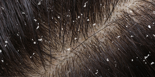 Kopfhaut mit trockenen Schuppen