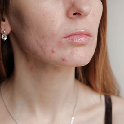 Akne tarda im Kinnbereich