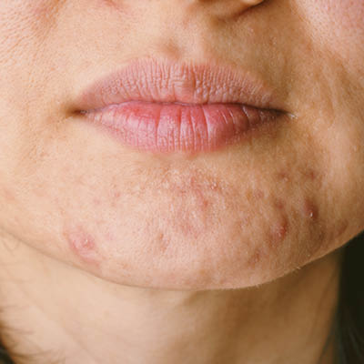 Akne tarda an der Kinnpartie