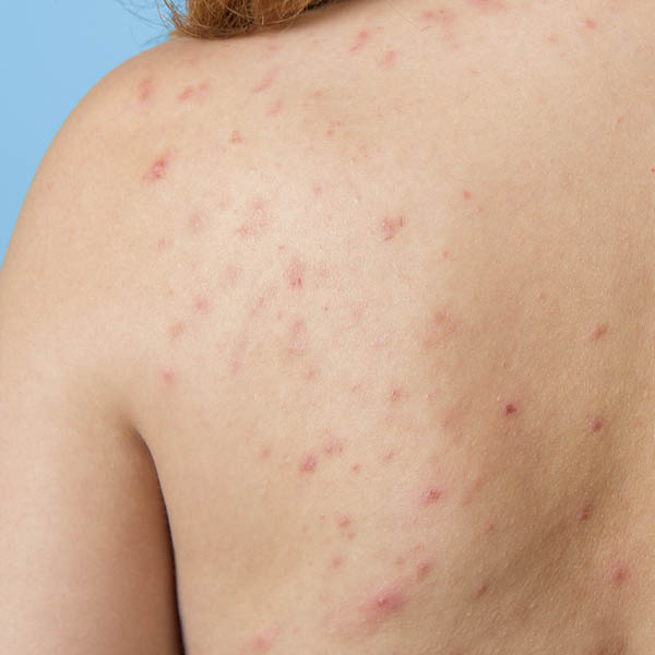 Rücken mit Akne