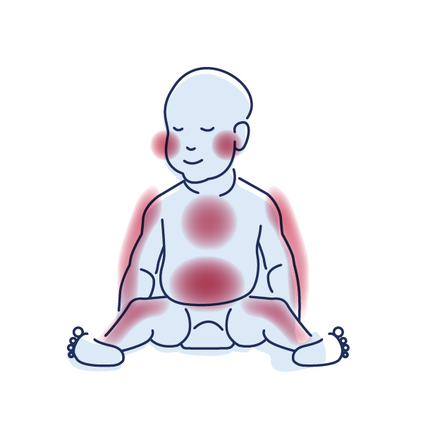 Grafik eines Babys, bei dem die betroffenen Hautstellen markiert sind