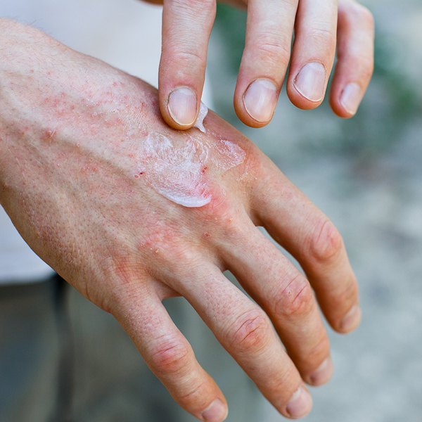 Hand mit einem Ekzem, die eingecremt wird