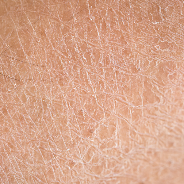 Fischschuppenkrankheit (Ichthyosis) – Entstehung & Behand