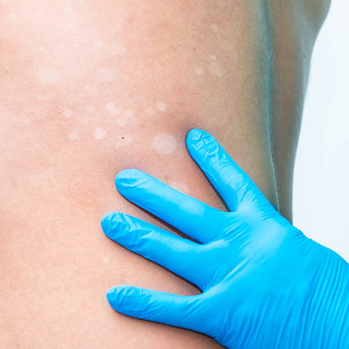 Foto einer Kleienpilzflechte