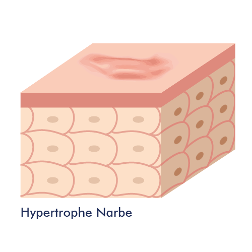Grafik: hypertrophe Narbe