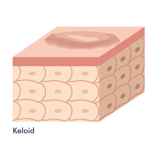 Grafik: Keloid