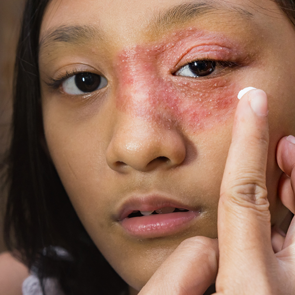 Frau mit einem Lidekzem, was sie eincremt