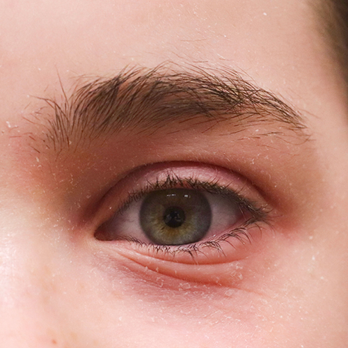 Auge einer an Neurodermitis erkrankten Person