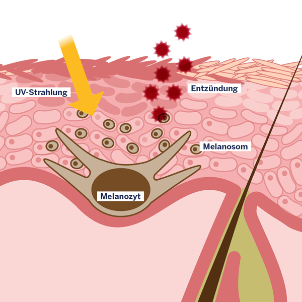 Grafik Postinflammatorische Hyperpigmentierung