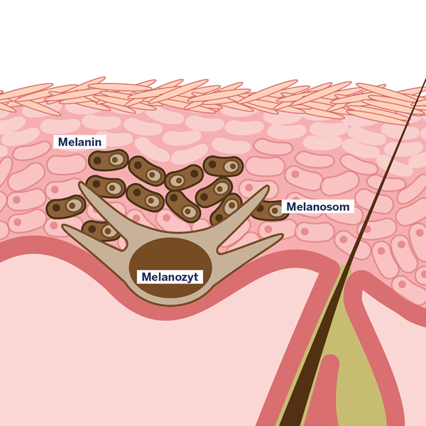 Grafik postinflammatorische Hyperpigmentierung