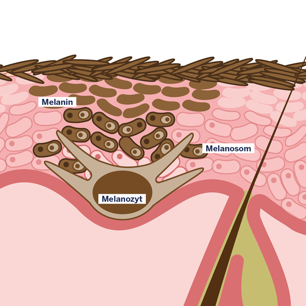 Grafik postinflammatorische Hyperpigmentierung