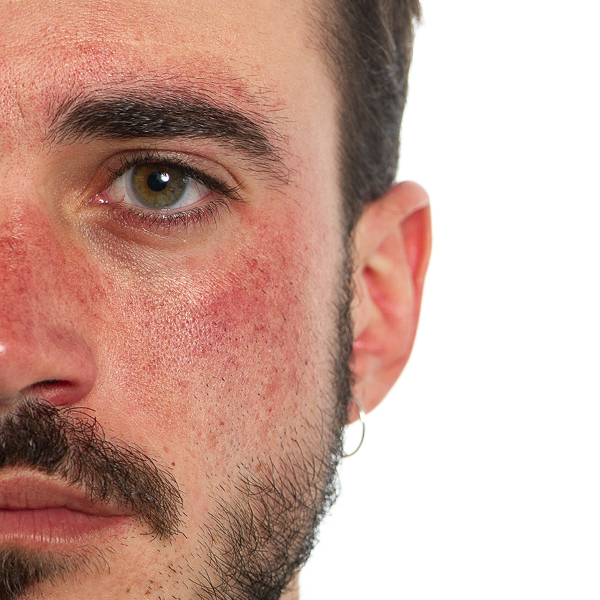 Bild einer von Rosacea geprägten Nase