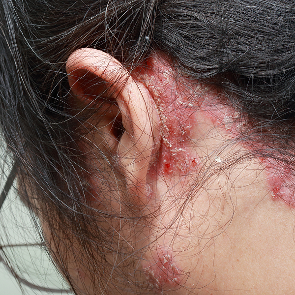 Foto einer Kopfhaut-Psoriasis am Haaransatz hinter dem Ohr