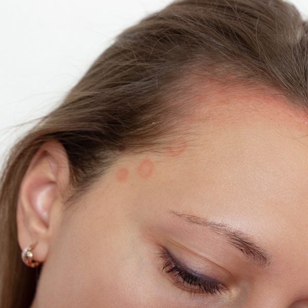 Frau mit Schuppenflechte am vorderen Kopf