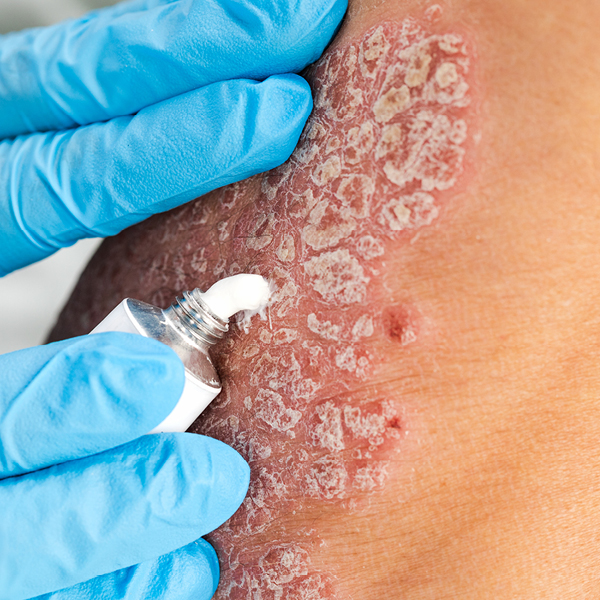 Schuppenflechte, die mit einer Creme behandelt wird.