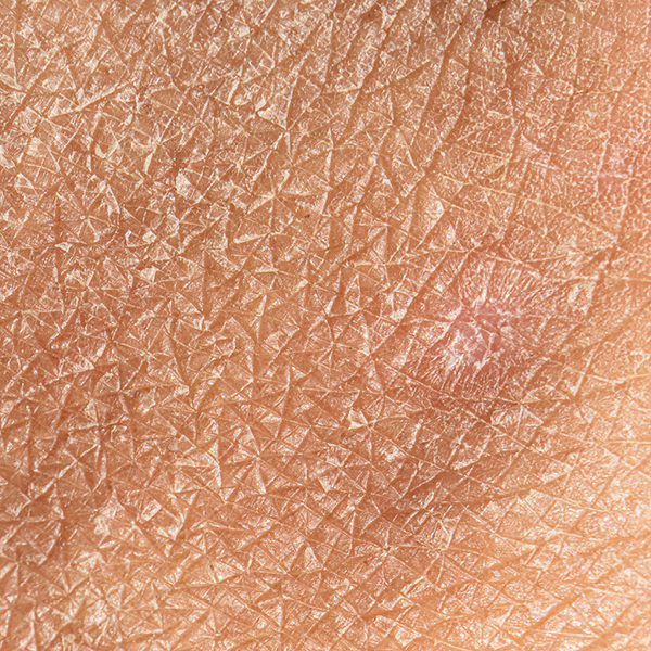 Nahaufnahme einer Sebostase (sehr trockene Haut)