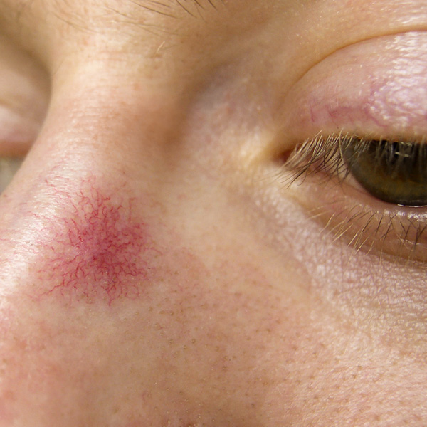 Bild zu Spider Naevi