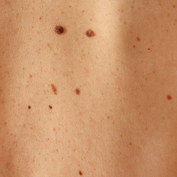 Ausschnitt der Haut mit Muttermalen