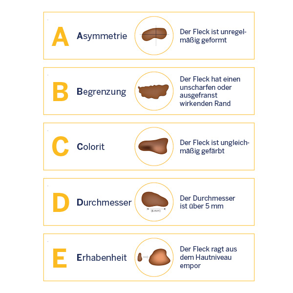 ABCDE Regel für das Screening von Muttermalen