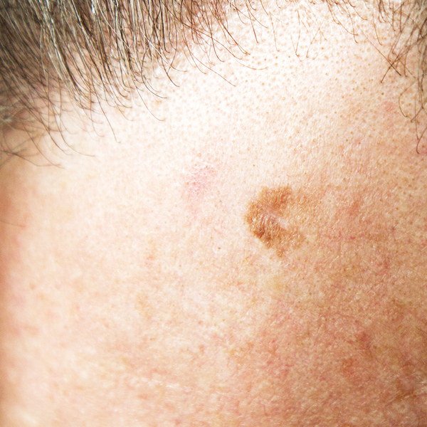 Lentigo maligna auf der Stirn