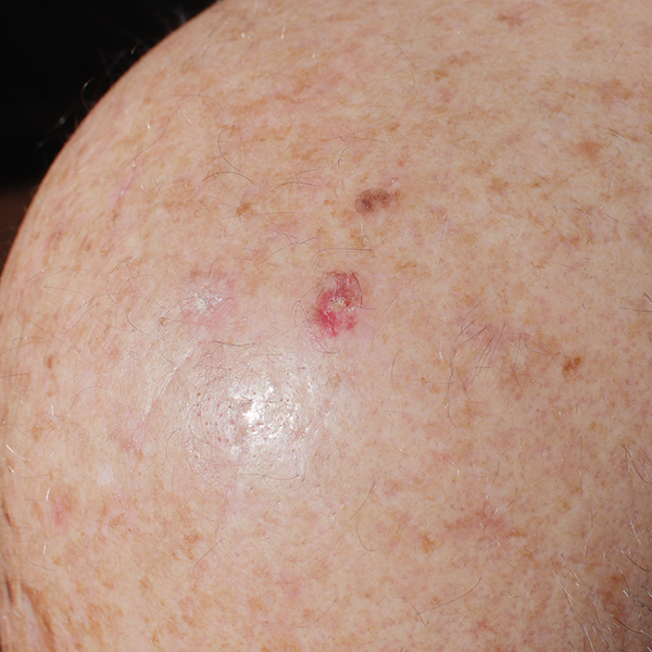 Pigmentiere Aktinische Keratose auf der Kopfhaut