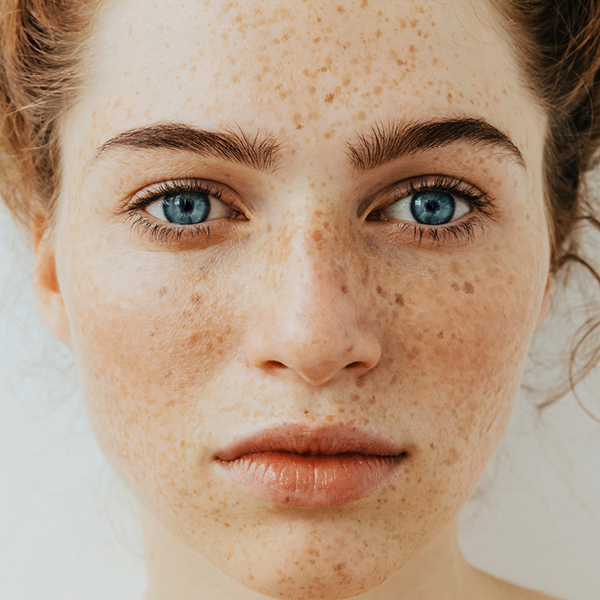 Frau mit Sommersprossen im Gesicht